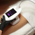 10x tselluliidiravi VelaShape Platinumiga