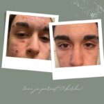 Ebapuhta naha ja aktiivse akne protseduur TMed Proga x4 pakett