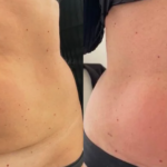 TMed kõhu rasvaeemaldus ja/või lõtvunud naha elavdamine 3X