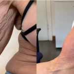 Lõtvunud käenaha elavdamine ja/või rasva vähendamine 6X pakett