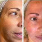 TMed Pro näo mikrolifting X5 pakett