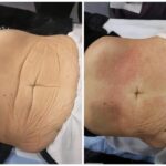 TMed kõhu rasvaeemaldus ja/või lõtvunud naha elavdamine 6X