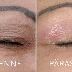TMed Silmaümbrus enne ja pärast